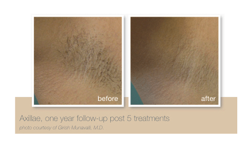 Underarm hair removal by Sheer Laser Clinic