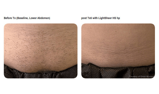 Stomach hair removal by Sheer Laser Clinic