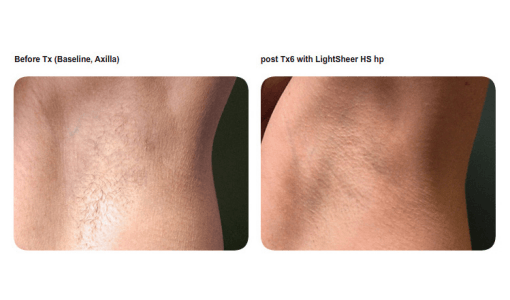 Underarm hair reduction by Sheer Laser Clinic