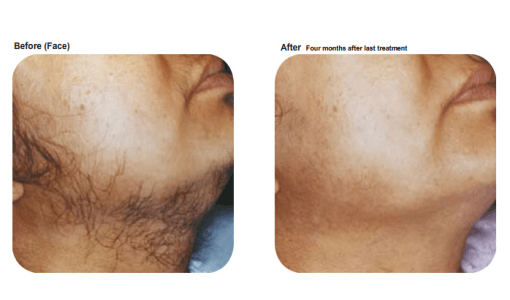 Chin hair removal by Sheer Laser Clinic