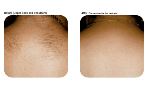 Neck hair removal by Sheer Laser Clinic