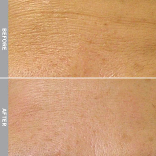 HydraFacial Before & After on Fine Line and Wrinkles