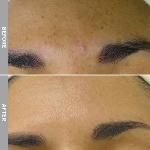 HydraFacial Before & After on Hyperpigmentation