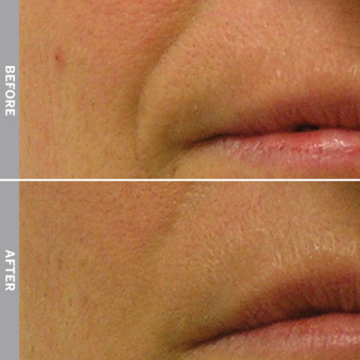 HydraFacial Before & After on Nasolabial Folds