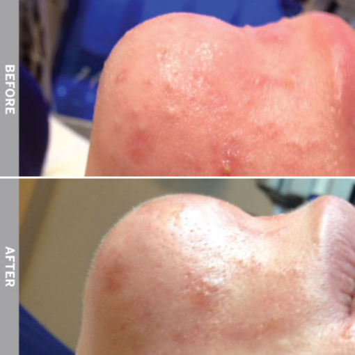 HydraFacial Before & After on Oily and Congested Skin