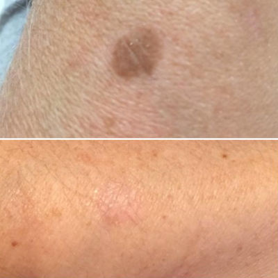 pigmentation removal cryopen