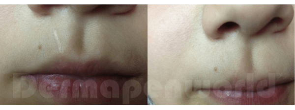 DERMAPEN™ SKIN MICRO NEEDLING treatment at Sheer Laser Clinic