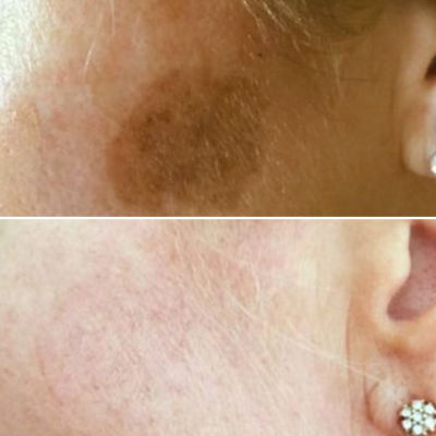 age spot removal pigmentation removal cryopen