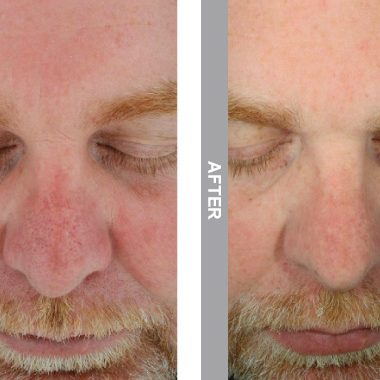 HydraFacial Before & After viewed using Polarized Imaging