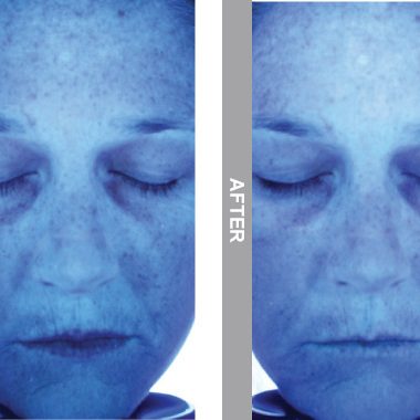 HydraFacial Before & After viewed on UV Digital Imaging