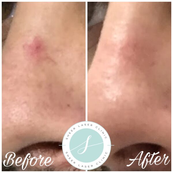 Thermavein® Thread Vein Removal • Sheer Laser & Skin Clinic • Twickenham