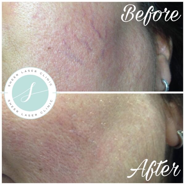 Thermavein® Thread Vein Removal • Sheer Laser & Skin Clinic • Twickenham