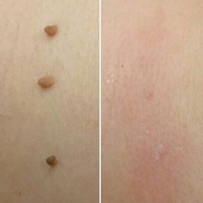 skin tag removal cryopen